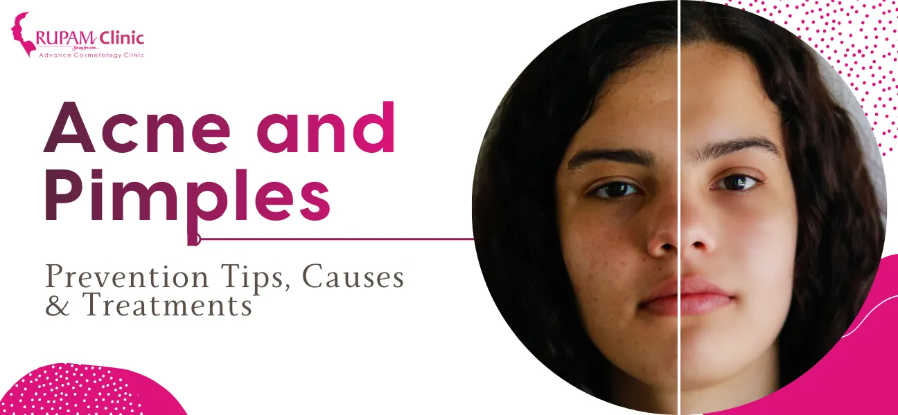 How to Cure Acnes and Pimple Marks?