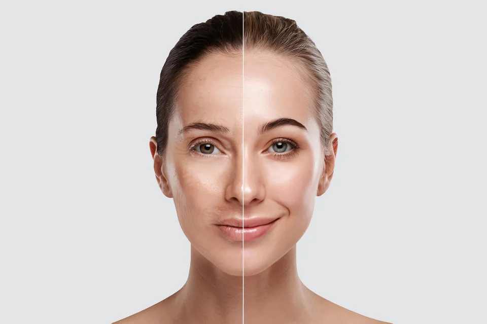 Dermabrasion Treatments | Rupam Clinic