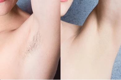 Dermabrasion Treatments | Rupam Clinic