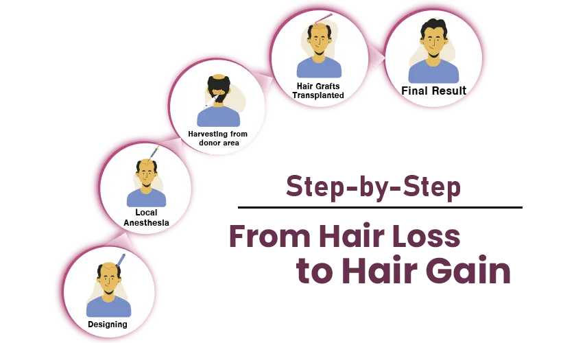 Stages of Hair Transplant: Rupam Clinic