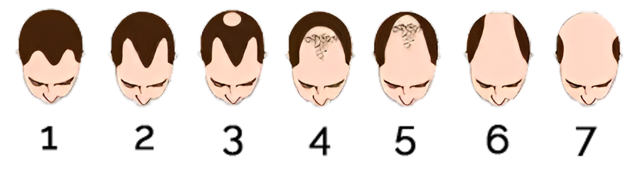 Baldness Levels