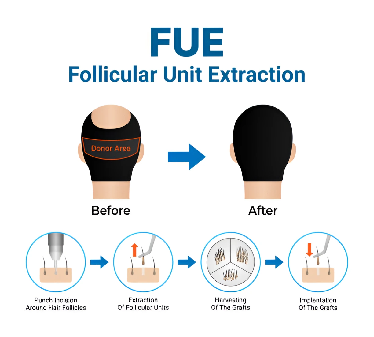 Hair Transplant Journey